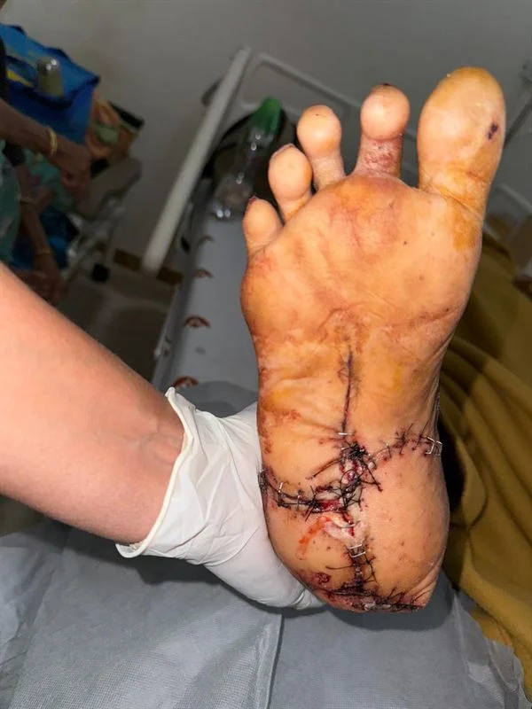 Functional Recovery - After Surgery
