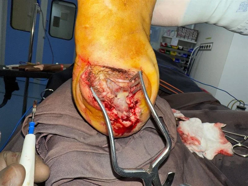 Wagner Grade 4 Ulcer Defect - Before Surgery